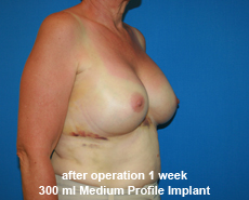 plastic-surgery-breast-augmentation